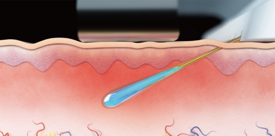 ニードルRFの針から薬剤が入っていくイラスト画像